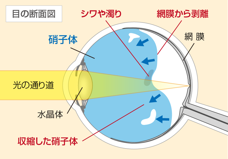 生理的飛蚊症の原因:1 「後部硝子体剥離」解説図案